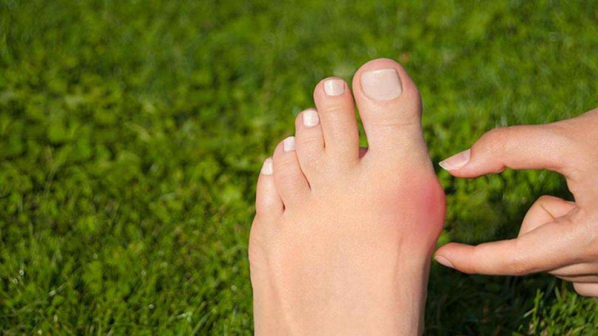 Hallux valgus o juanetes: descubre los síntomas y tratamientos más eficaces