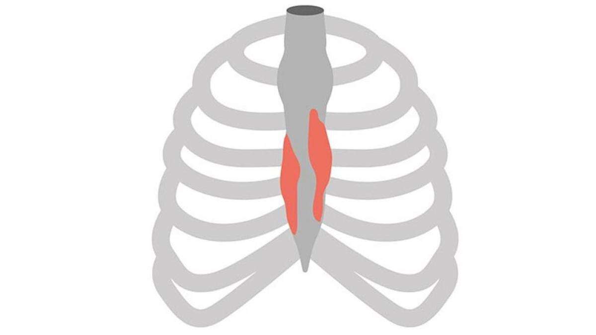 Costocondritis, qué es y cómo aliviar sus síntomas