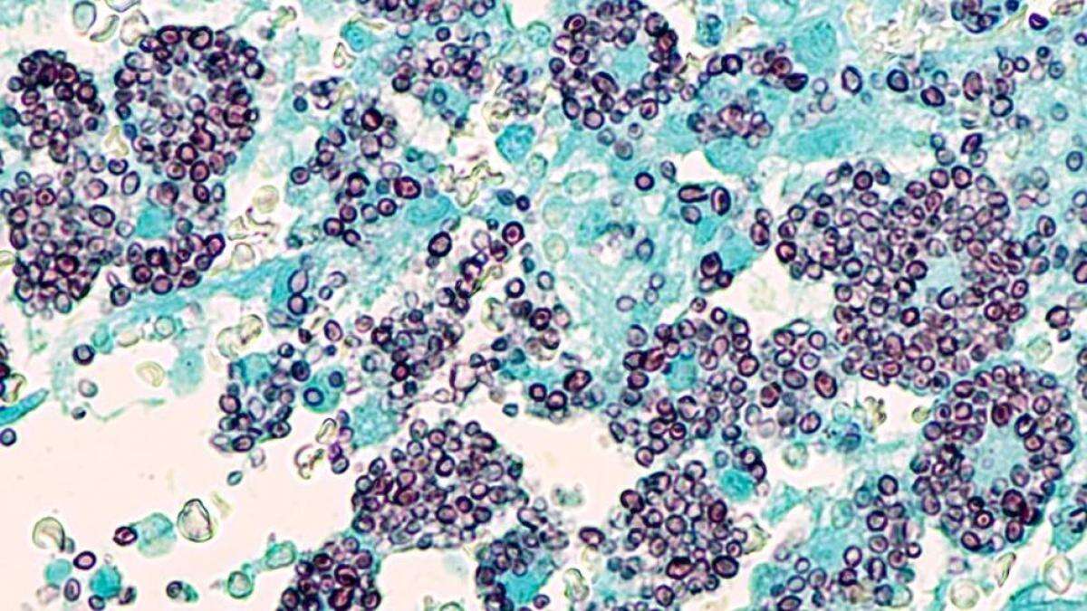 Histoplasmosis: qué es, causas y cómo tratar esta infección fúngica