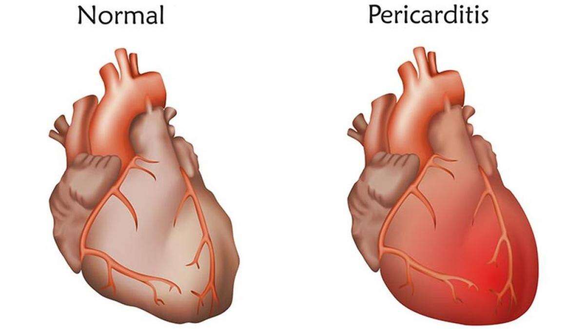 Pericarditis: cómo identificar los síntomas y tratar la inflamación del pericardio