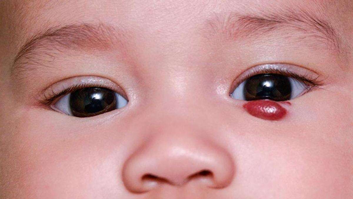 Hemangioma: qué es y cómo tratar esta formación anómala de vasos sanguíneos