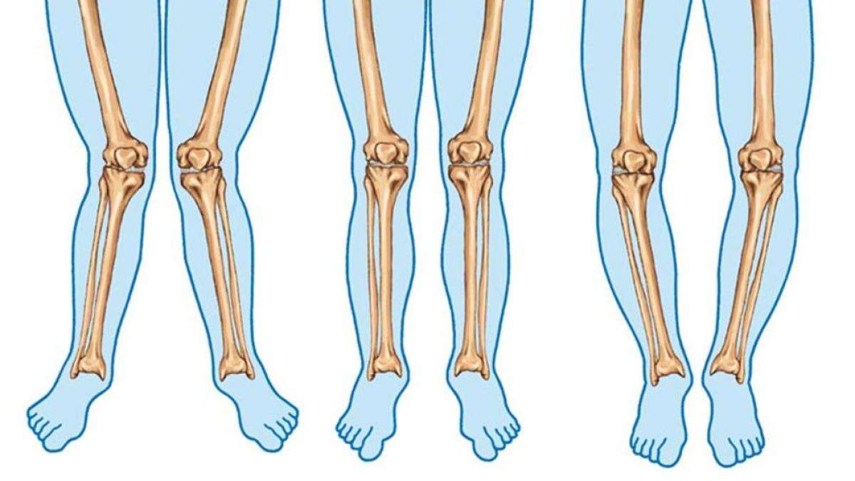 Genu valgo, síntomas y causas que debes conocer