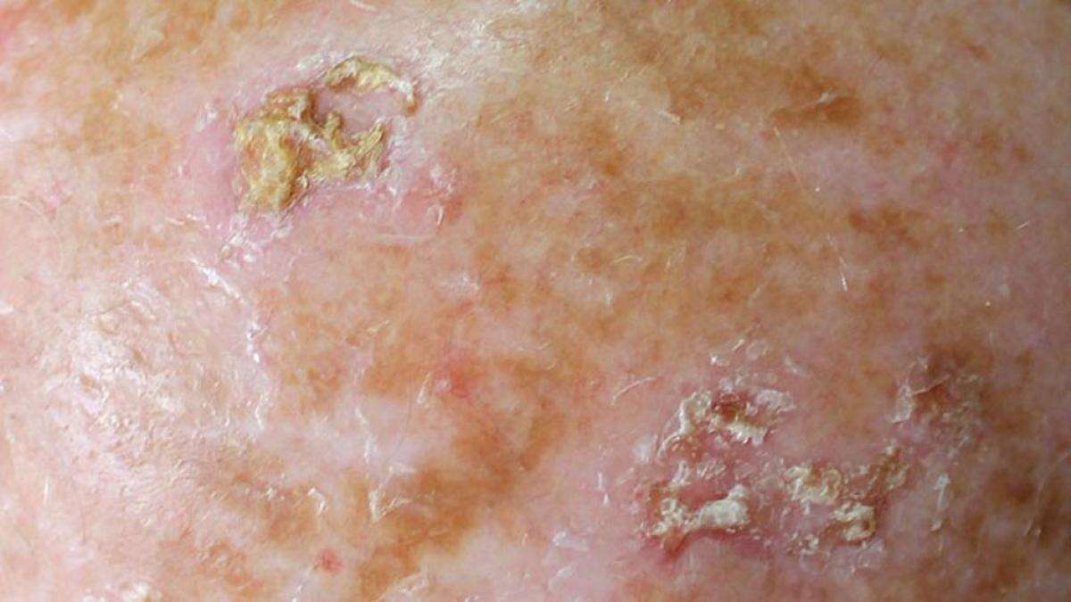 Queratosis actínica con síntomas, causas y opciones de tratamiento disponibles