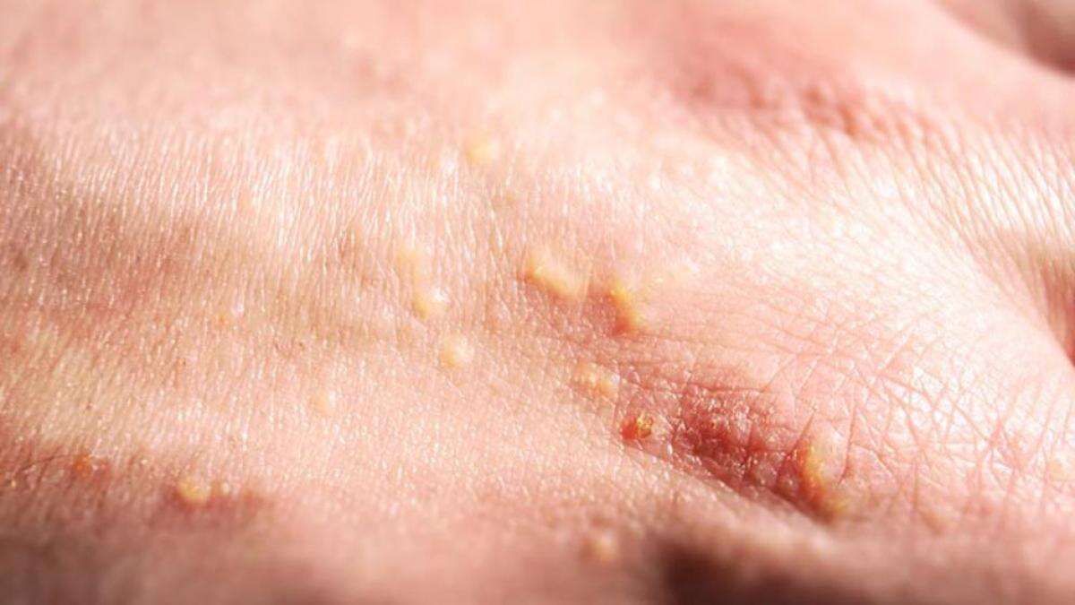 Alergia al sol: descubre sus síntomas y las mejores soluciones para tratarla