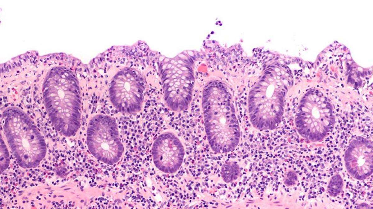 Colitis microscópica, síntomas y tratamientos más efectivos