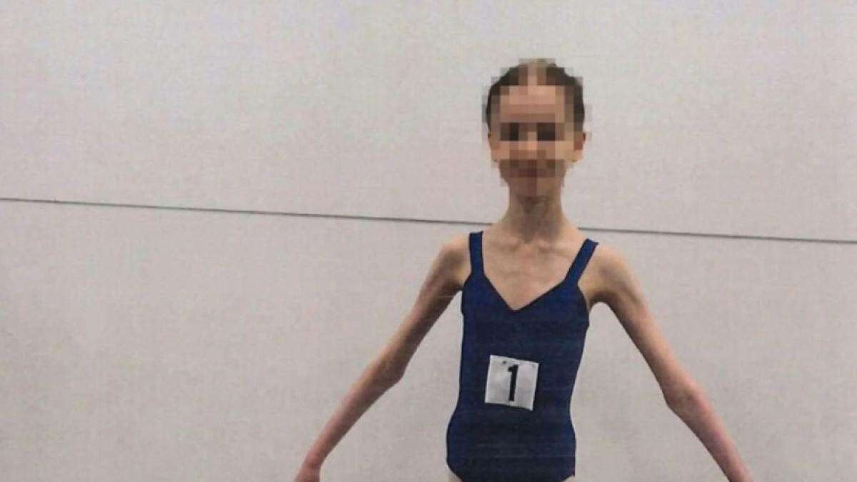 Cárcel para los padres que privaron de comida a su hija bailarina de 17 años, que pesaba como una niña de 9