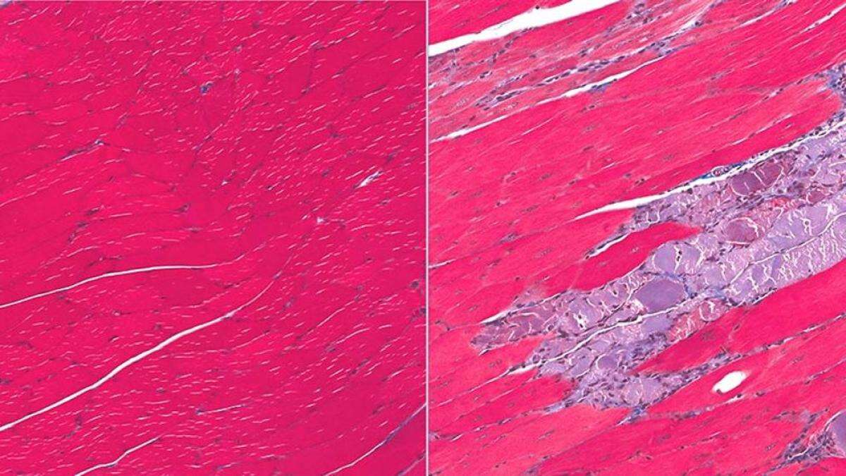 Distrofia muscular, síntomas y causas que no puedes ignorar