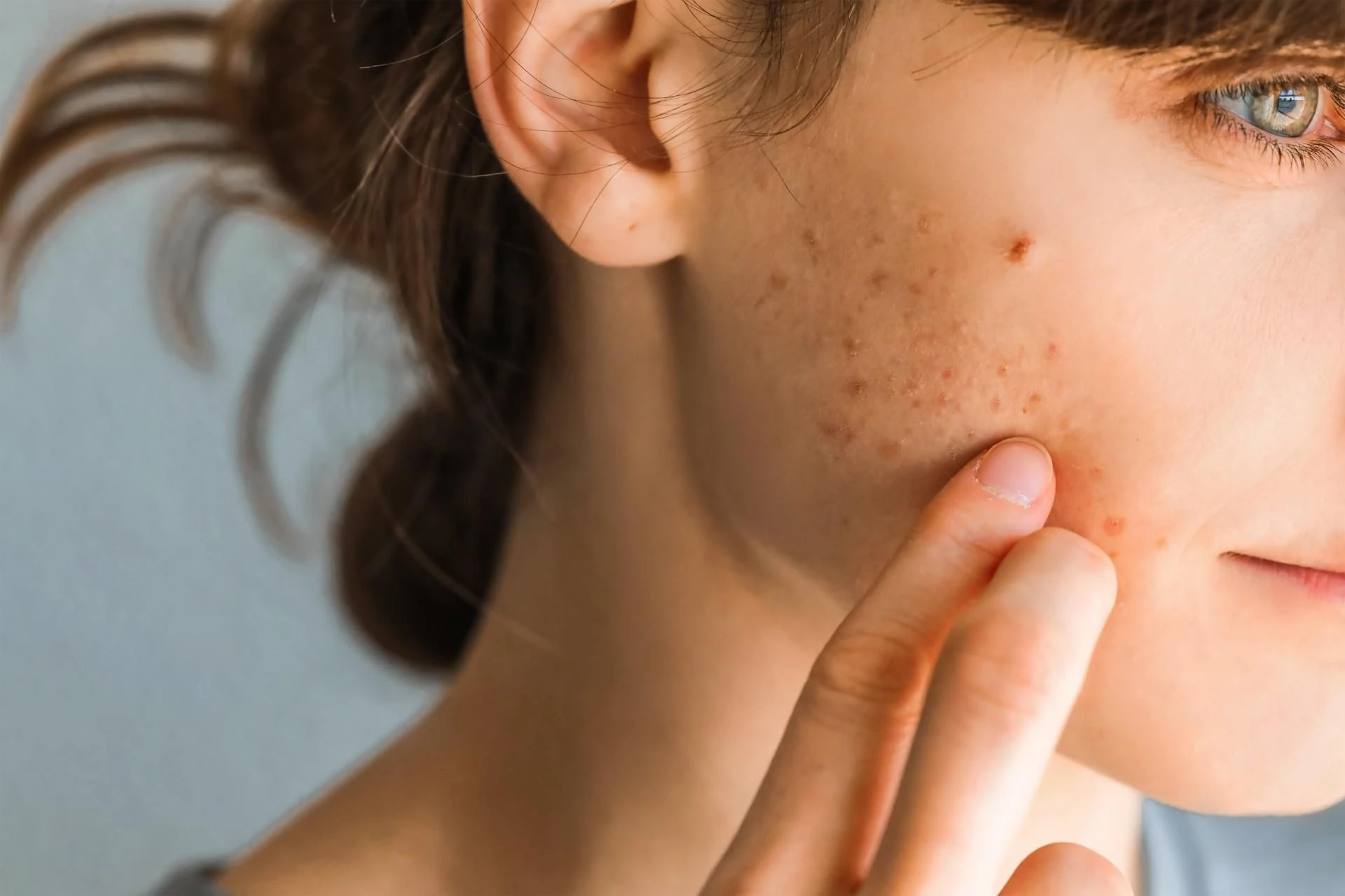 Strefa beauty Trądzik dorosłych – na co zwracać uwagę pielęgnując skórę, która traci jędrność, gdy…