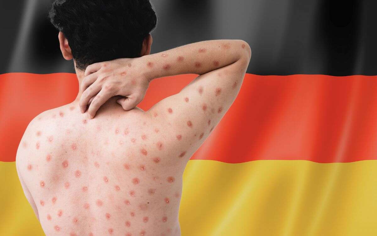 Alemania confirma su primer caso de la nueva variante de mpox