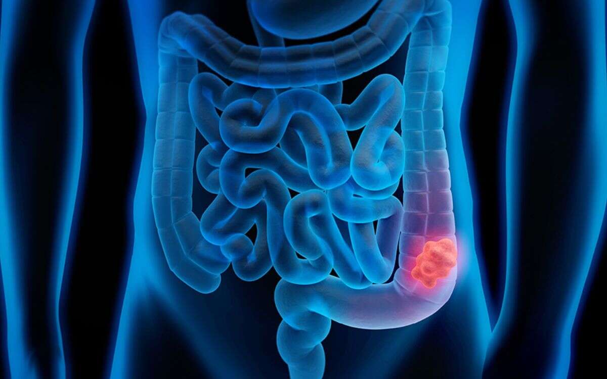 El cáncer colorrectal aumenta en jóvenes de países de ingresos altos