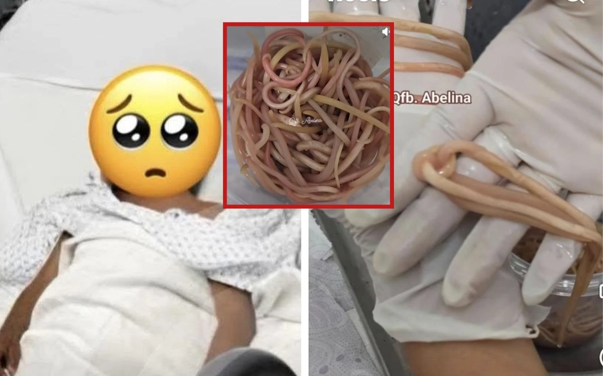 Un niño llega con dolor abdominal y le extirpan 142 lombrices del intestino en Chiapas