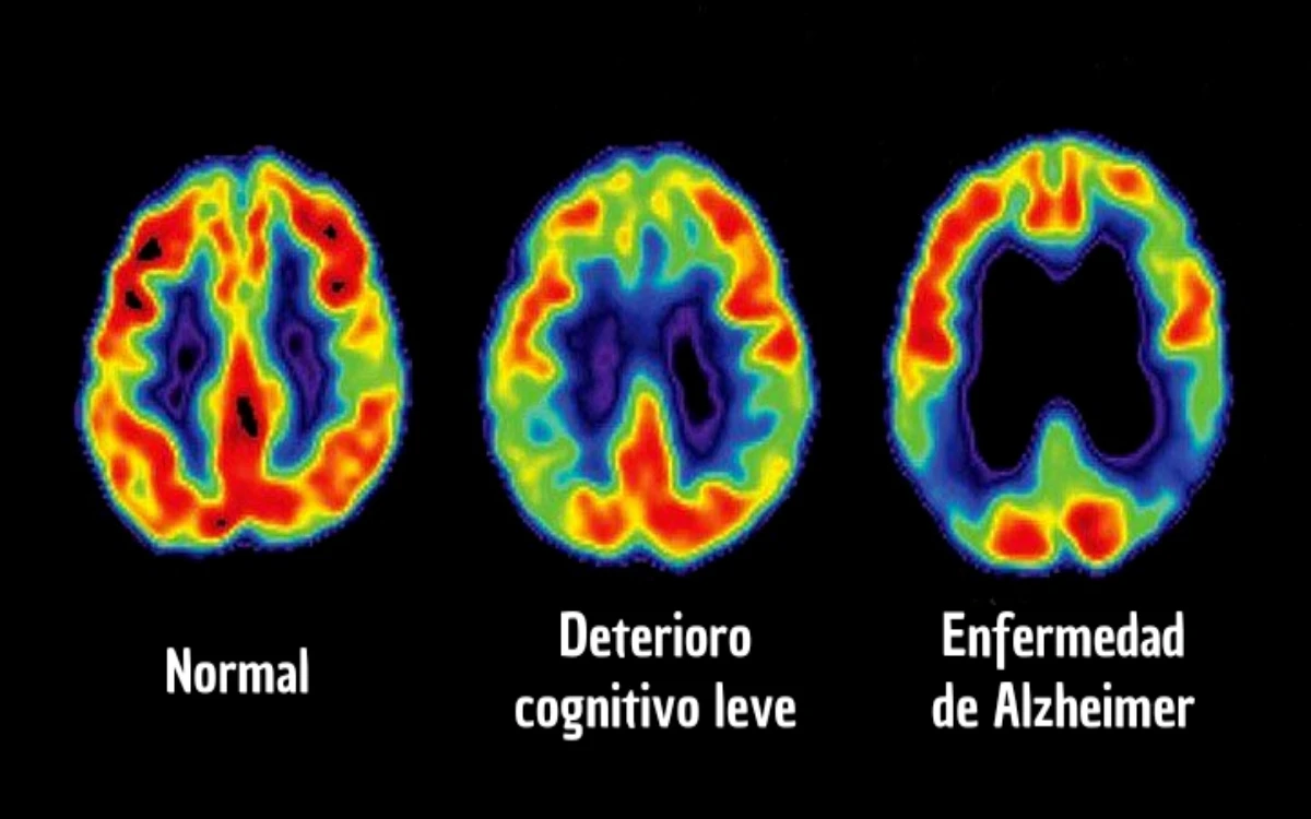 Dan a conocer una forma de detectar Alzheimer en fases tempranas