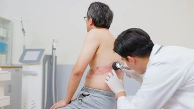 Zona : un nouveau vaccin efficace à 80 % contre cette maladie virale