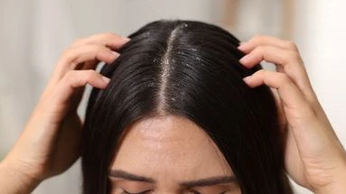 Vous avez des pellicules ? Voici comment savoir si elles sont grasses ou sèches (et quoi faire)