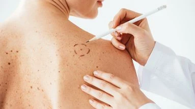 Cette méthode simple et conseillée par les dermatologues permet de surveiller vos grains de beauté