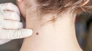 Pénurie de dermatologues : comment fonctionne le contrôle des grains de beauté en pharmacie ?