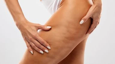Peut-on vraiment se débarrasser de sa cellulite ?