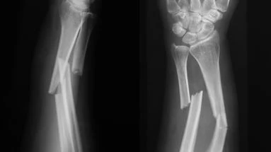 Vous pourrez bientôt réparer votre fracture du bras à l’aide… d’une huître !