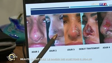 Beauté à tout prix : le danger des injections illégales