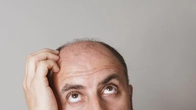 La calvitie, c'est bientôt fini ? Un sérum prometteur vient d'être mis au point par des chercheurs