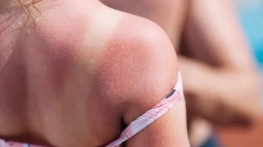Ces gestes à bannir absolument si vous attrapez un coup de soleil