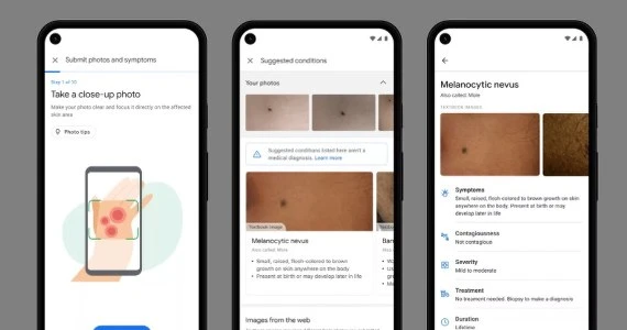 ​Nietypowy pieprzyk lub wysypka na skórze - Google sprawdzi, czy to coś poważnego