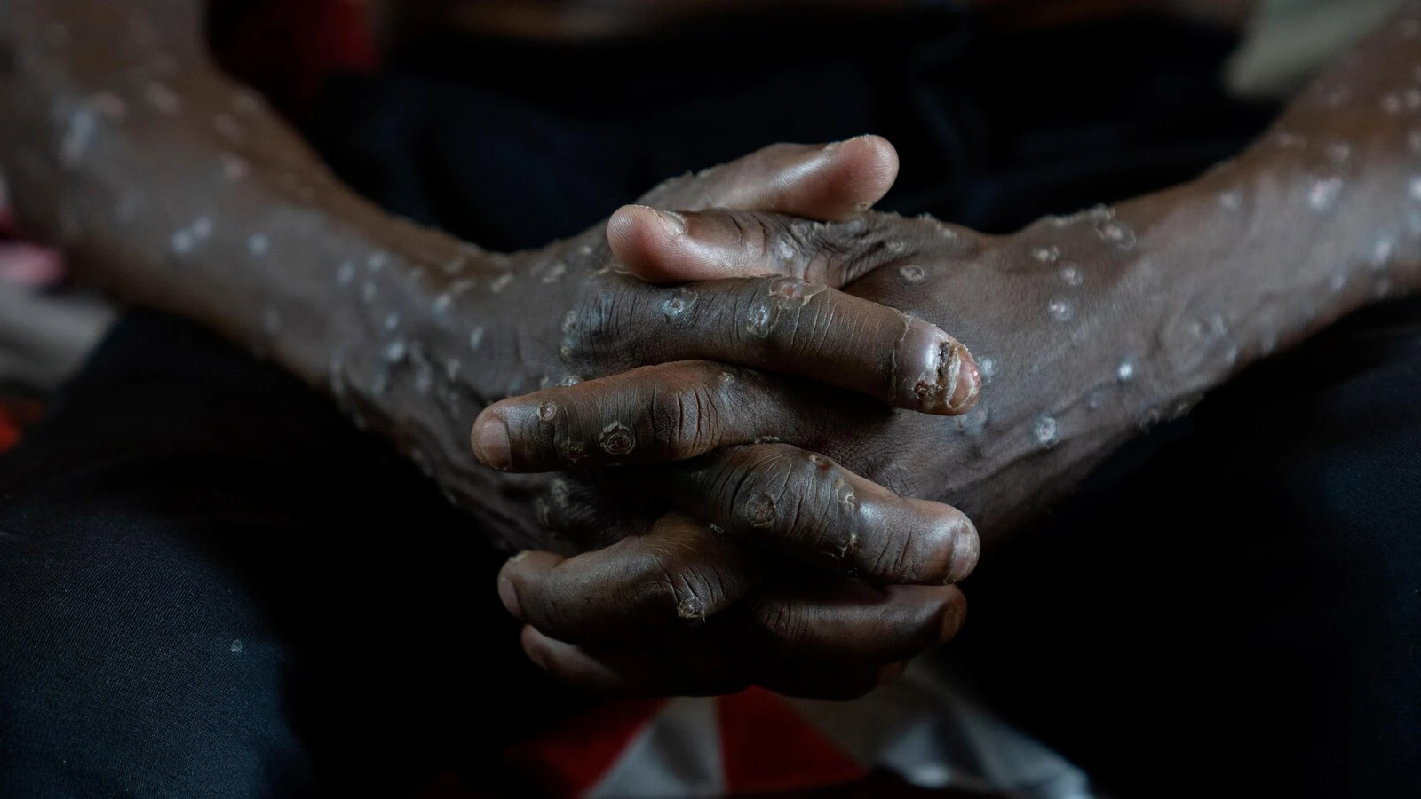 Congo says its mpox outbreak is over after 2 years and more than 2,200 suspected deaths