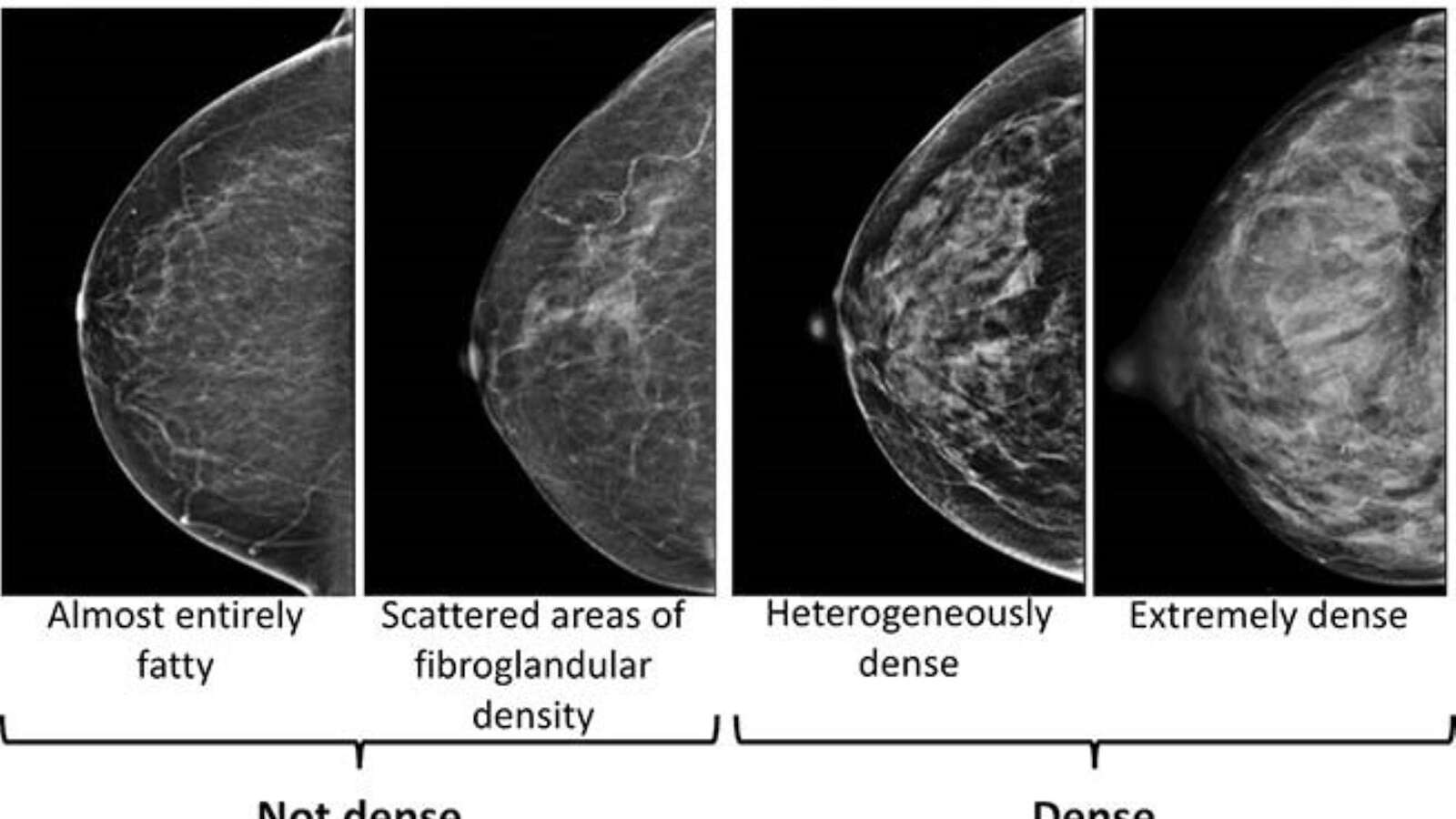 Dense breasts can make it harder to spot cancer on a mammogram