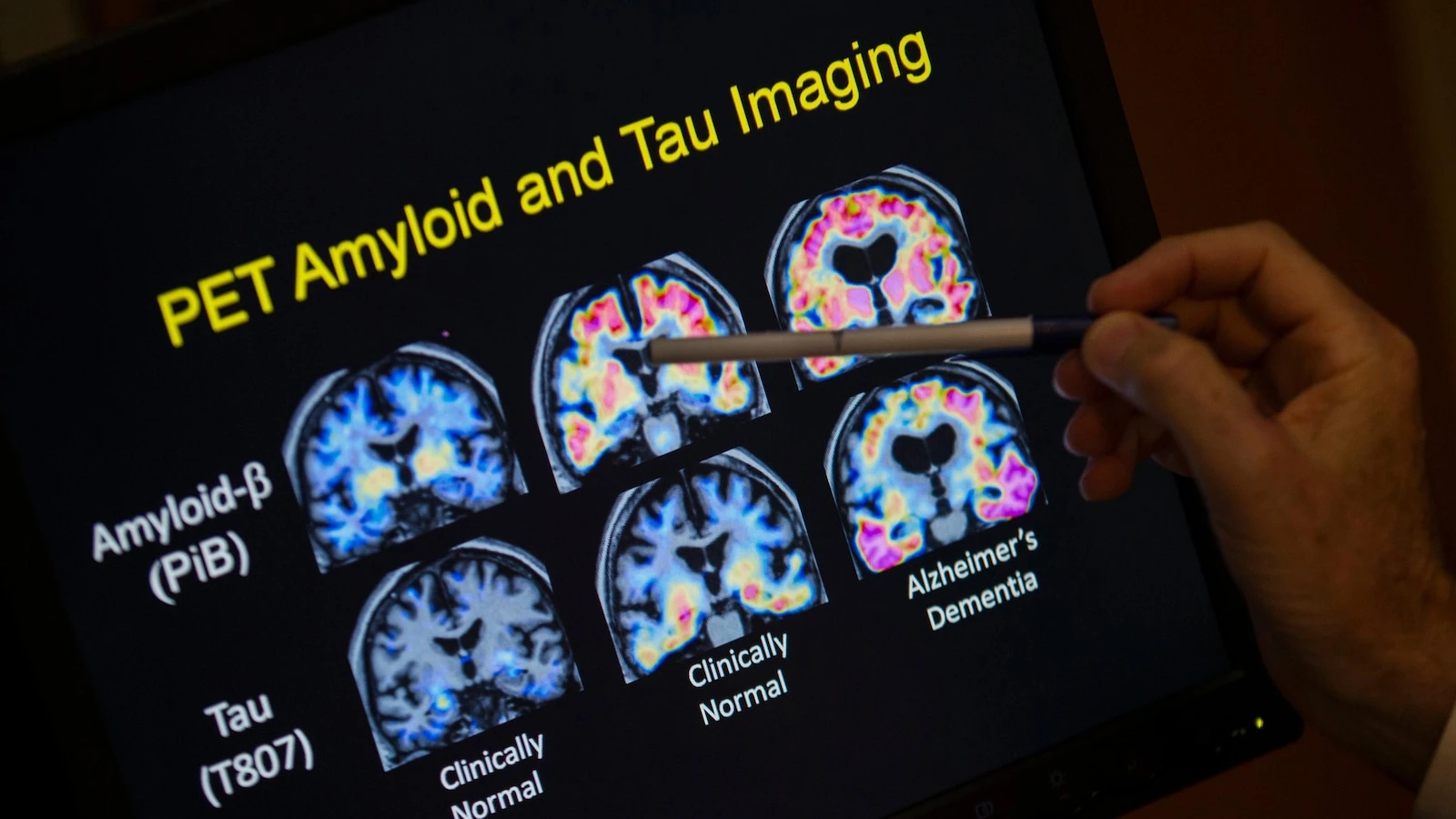 FDA OKs blood test to help diagnose Alzheimer's