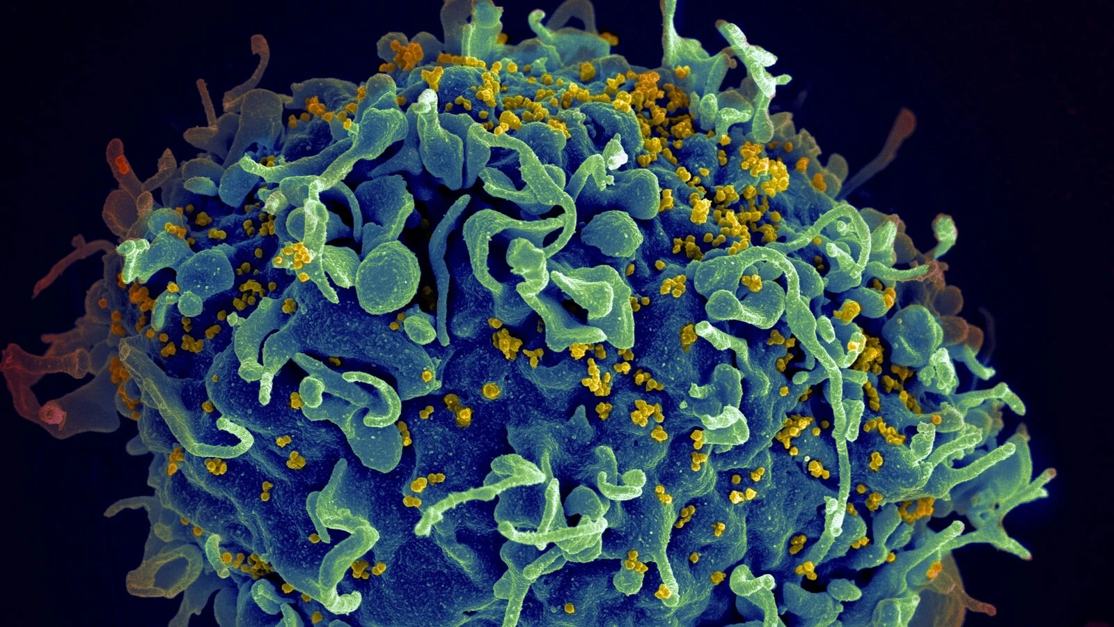 UN says if US funding for HIV programs is not replaced, millions more will die by 2029