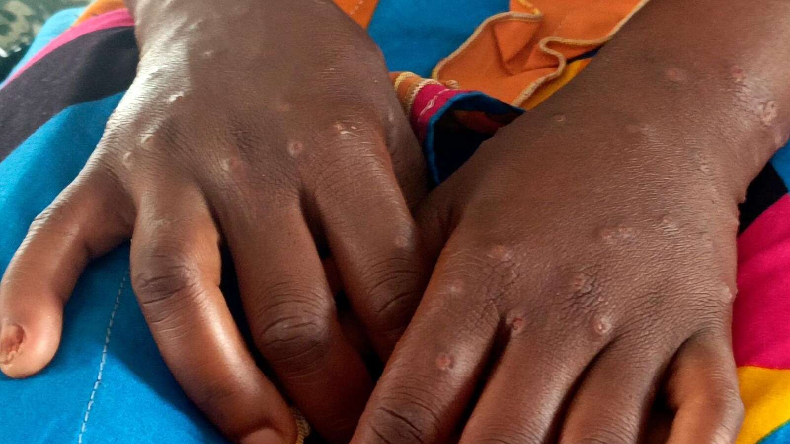 US aid cuts are hurting Africa's ability to respond to disease outbreaks, health chief says