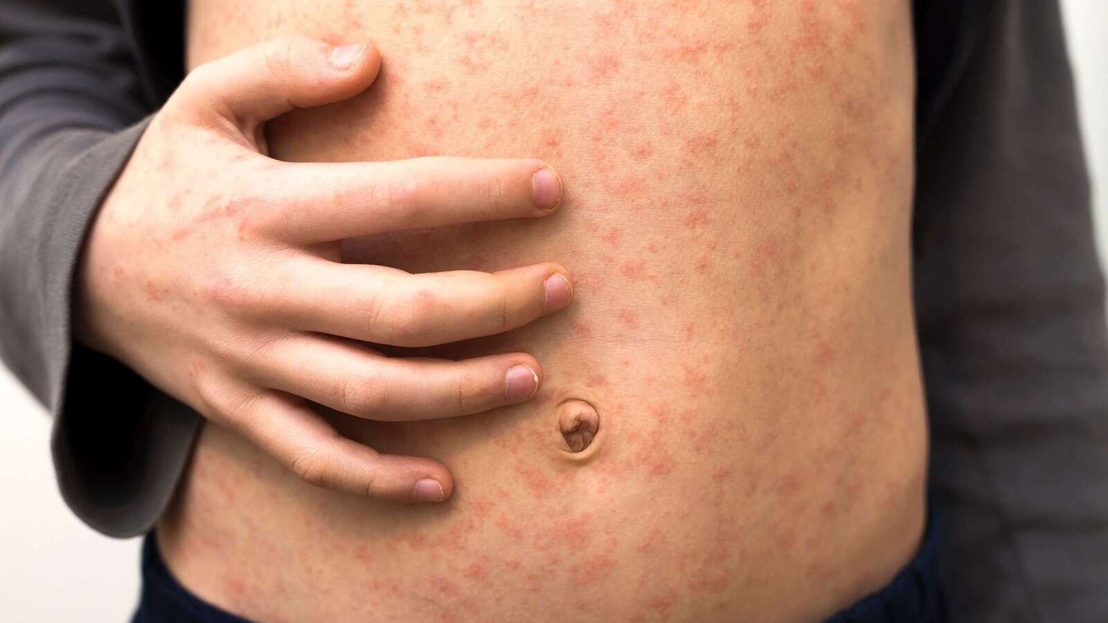 Why does the US keep seeing measles outbreaks?