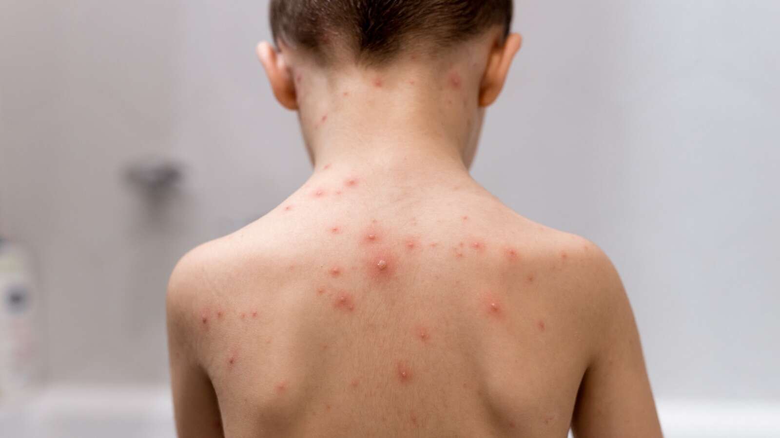 Most NYC chickenpox cases among unvaccinated