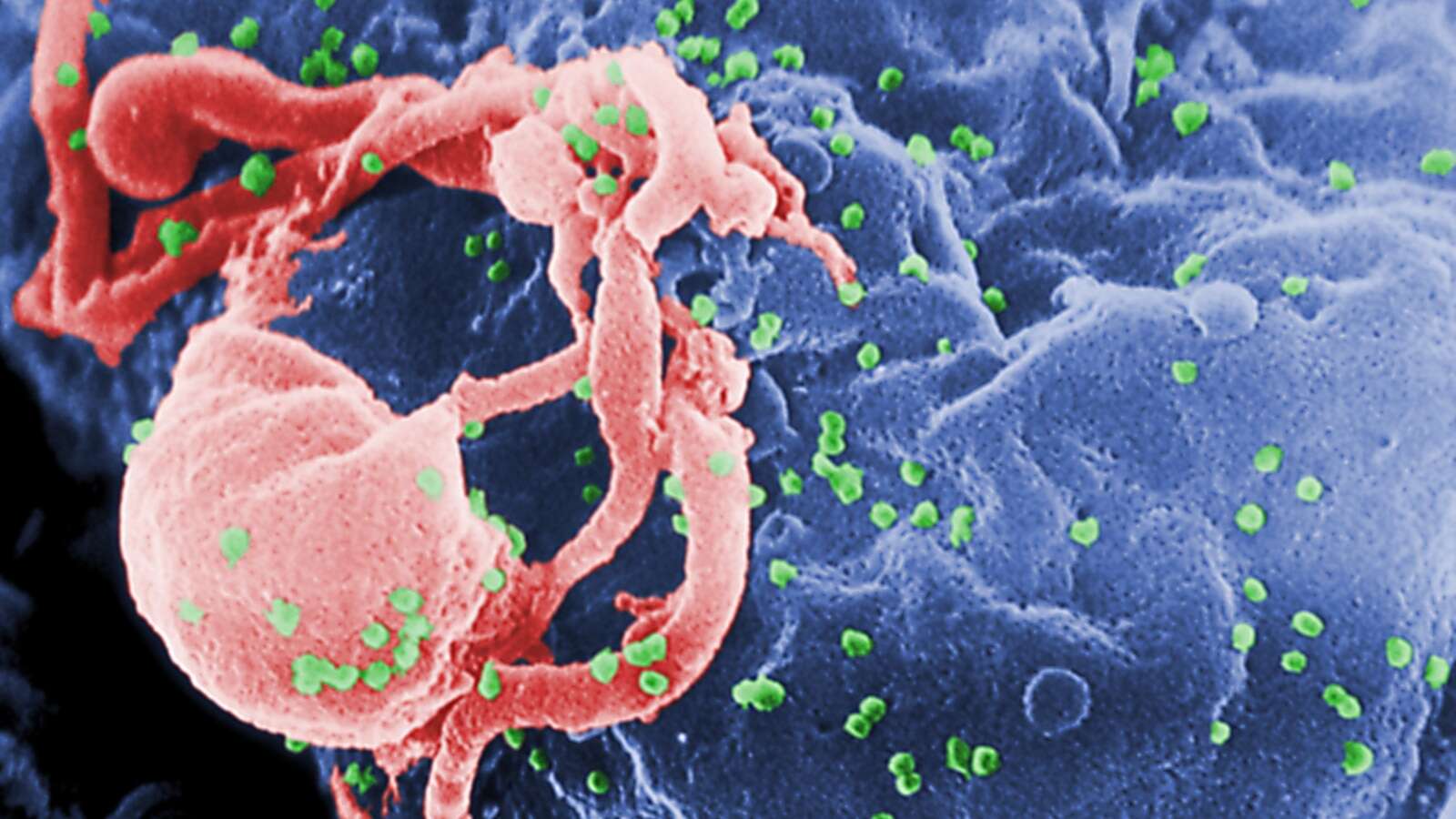 4 children surpass a year of HIV remission after treatment pause: Study