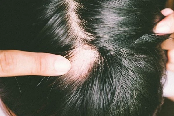 Kulit Kepala Botak dengan Bentuk Pitak? Mungkin Itu Alopecia Areata