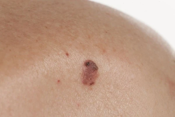 9 Fakta Melanoma, Jenis Kanker Kulit yang Disebut-sebut Paling Ganas