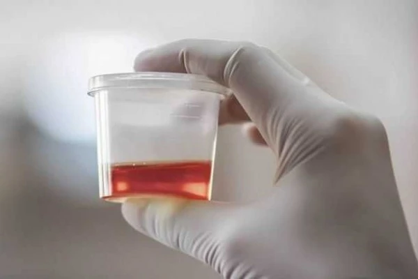 Kenali Hematuria, Bikin Urine Berwarna Merah seperti Darah atau Teh 