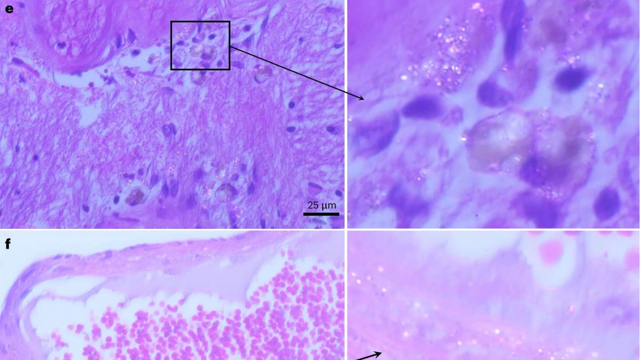 Microplastiche nel cervello umano in quantità allarmanti, pari a un intero cucchiaino