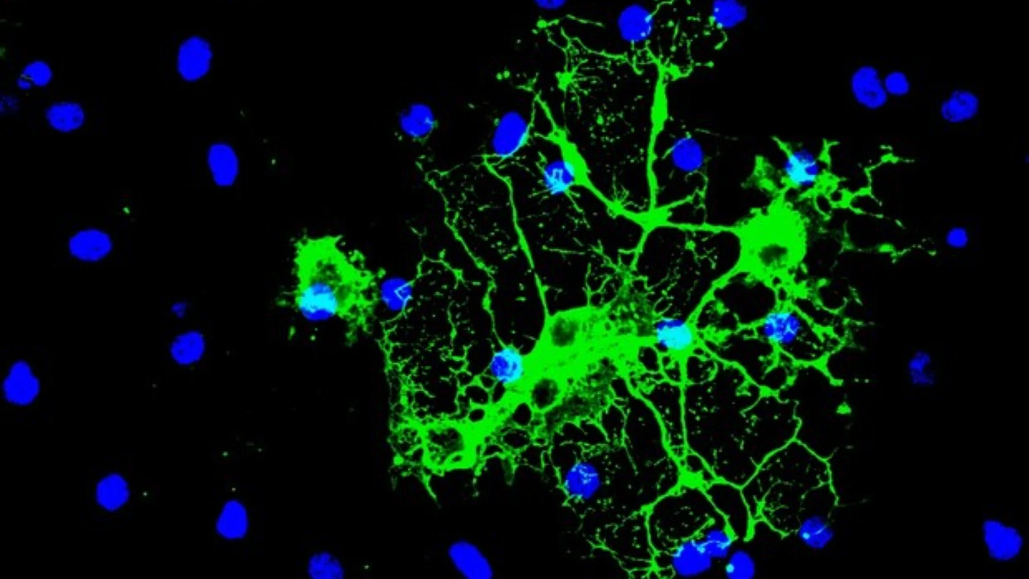 Sclerosi multipla, scoperto nuovo meccanismo di declino cerebrale