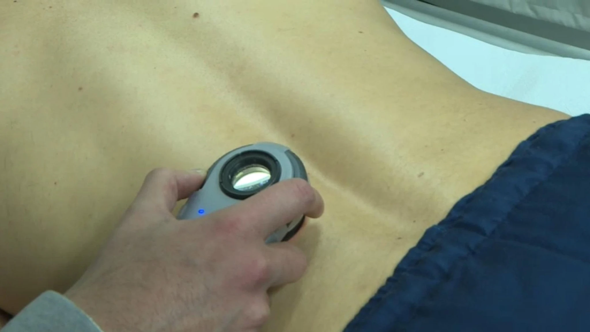 Tumori della pelle, Ascierto: 