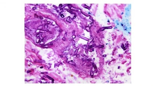 Dokter Temukan Kasus Infeksi Jamur Hijau, Begini Gejalanya!