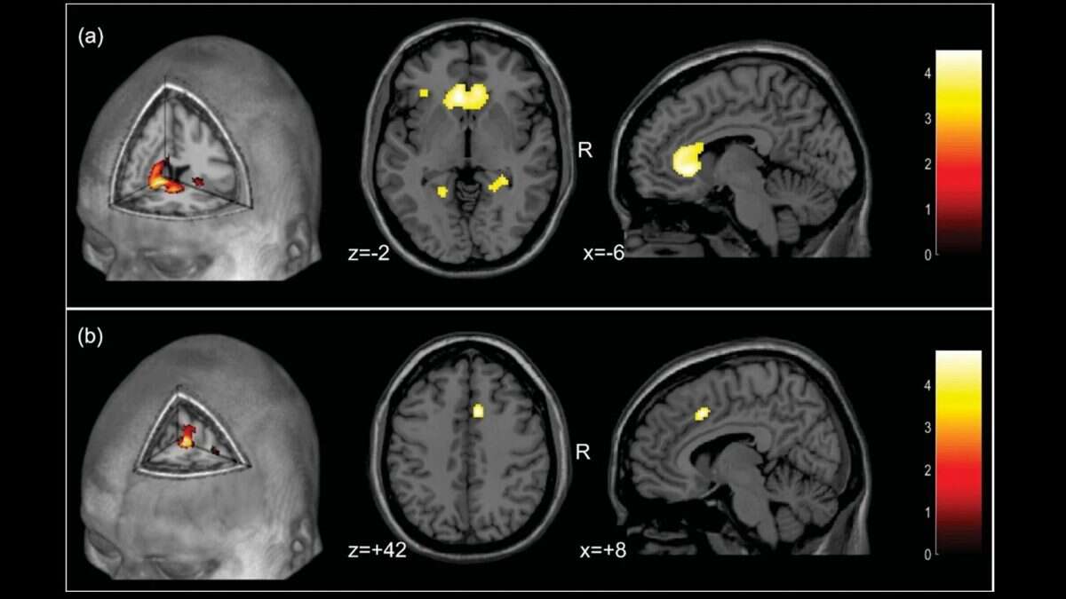 Cancro, bloccata la diffusione delle metastasi al cervello in laboratorio: scoperto “gene bersaglio”