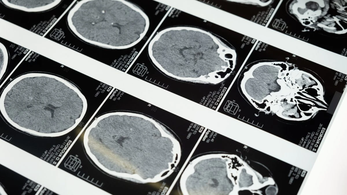 Questo test del sangue può rilevare il tumore al cervello: come funziona