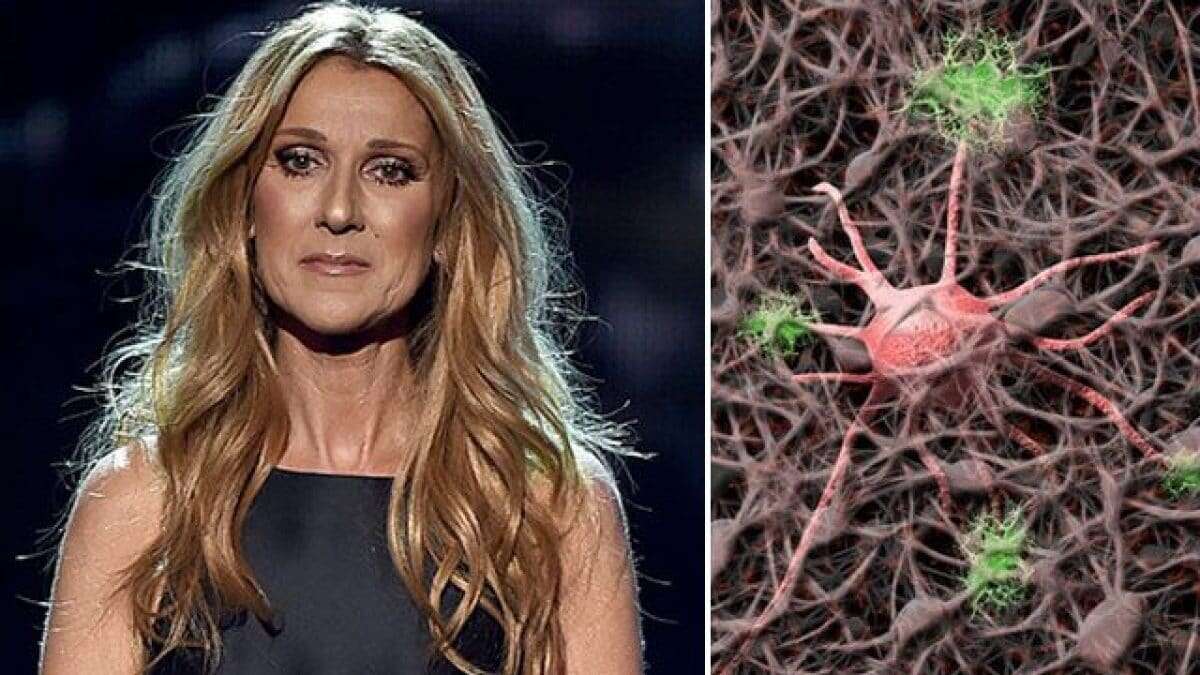 Qual è la malattia di Céline Dion, sintomi e cura della sindrome della persona rigida