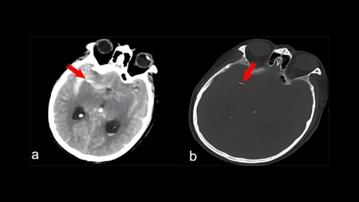 Va in ospedale in stato confusionale ma scopre di avere un ago per l’agopuntura nel cervello