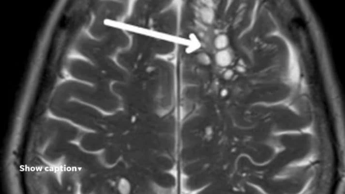 Mangia bacon e si ammala: come la tenia del maiale può infettare il cervello