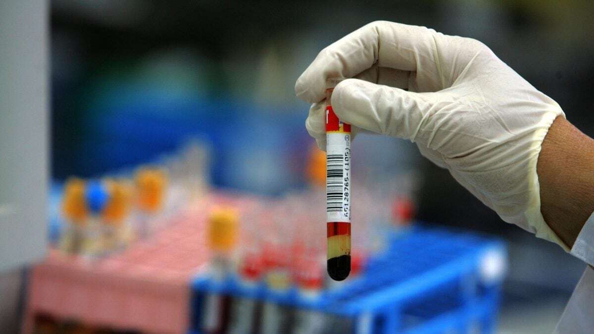 Cancro, test del sangue rileva oltre 50 tumori con una precisione del 75%: come funziona