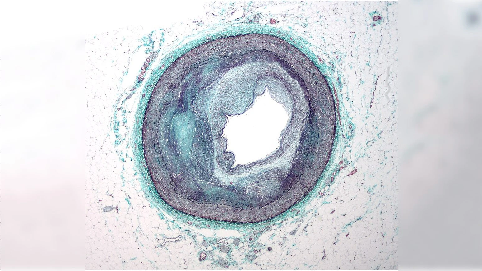 Plastica scoperta anche nel grasso delle arterie ostruite: rischio di infarto, ictus e morte