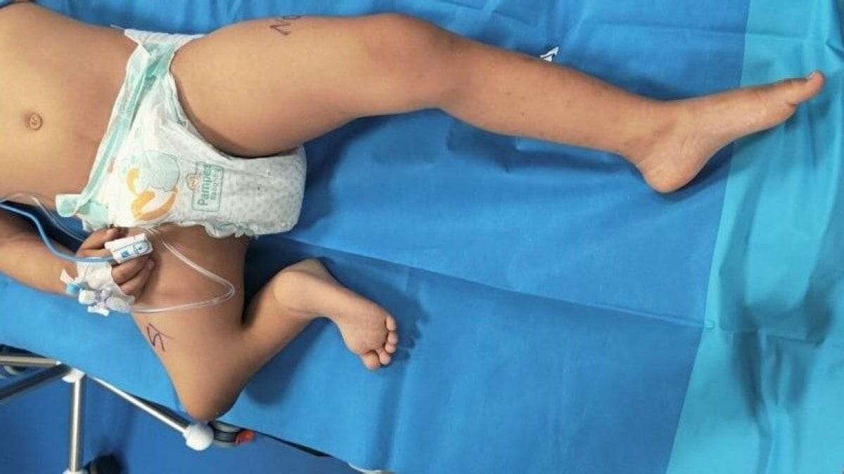 Bimba di 3 anni ha una malformazione alla gamba: cammina per la prima volta dopo un intervento