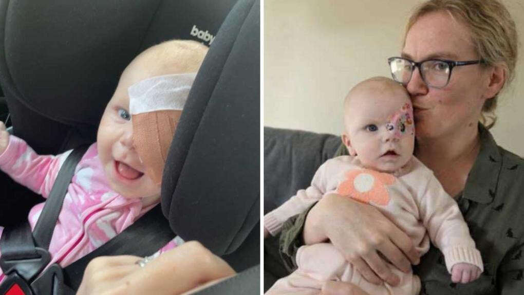 Subtle change that led doctors to remove Aussie baby’s eye